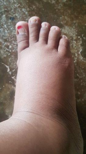 Kaki bengkak dan sering kram