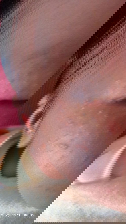 Obat beruntus yang baik untuk bayi