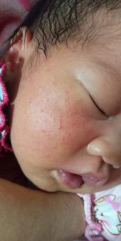 น้องมีผื่นขึ้นที่แก้ม จะรักษายังไงไห้หายค่ะ