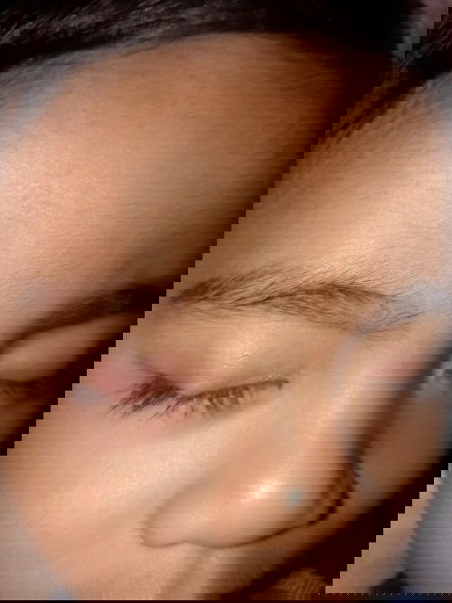 Kulite Po ba tlg sya ano Po kaya eto sana Po my makapansin sa tanung ko po at kung my gamot Po b pra