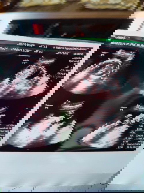 Penasaran sama hasil usg