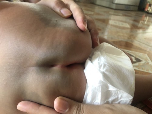 Có mom nào có con giống Con em không ạ.con em bị 1 lỗ lõm ở mông. Không biết có ảnh hưởng gì không