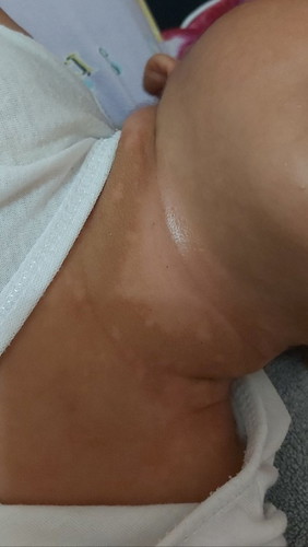 Mga moms normal lng po ba yan sa leeg ni baby kapag laging nababasa ng gatas, 43 day plng ng baby ko