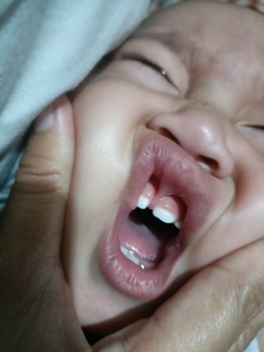 Lip tied baby