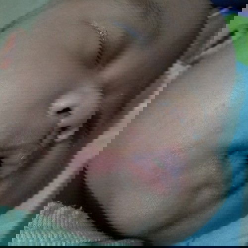 Ruam asi atau alergi?