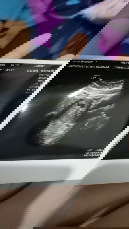 USG 6week2day pada pcos