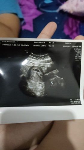 USG 6week2day pada pcos