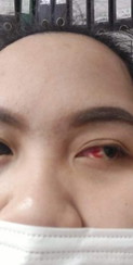 เลือดฝอยตาแตก