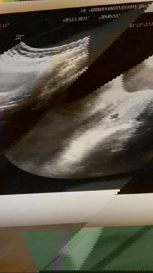 Hasil usg pertama umur 2 minggu ini beneran kn ya.. hitungan dokter msih 2 minggu tp klo d hitung dari haid terakhir 5