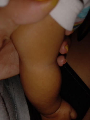 hand foot mouth disease po sakit ng baby ko