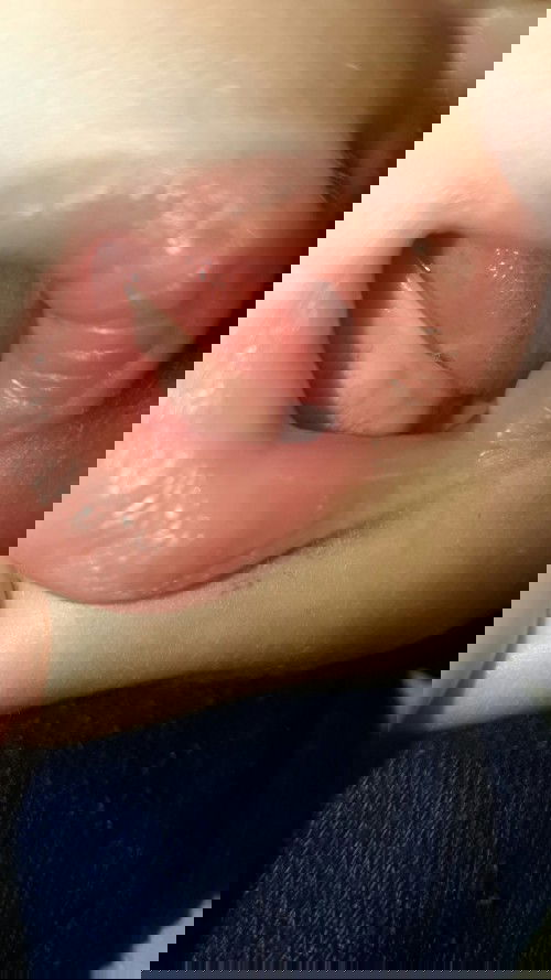 Ujung lidah bayi bintik merah seperti darah