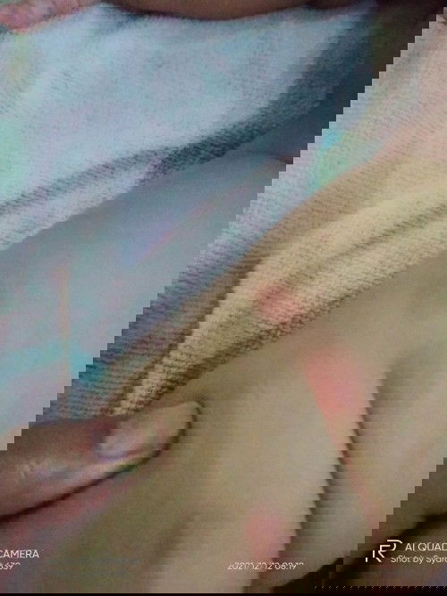 Bercak merah di kulit bayi