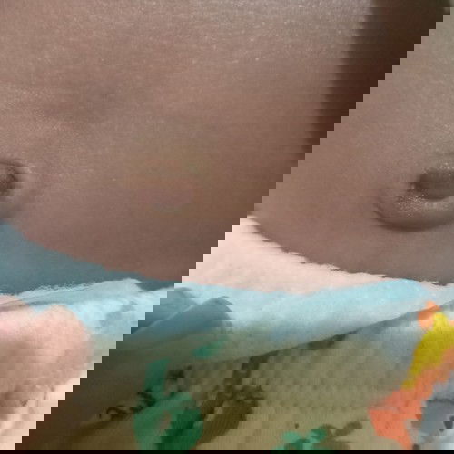 Pusar Bayi 1 bulan masih basah dan ad benjolan