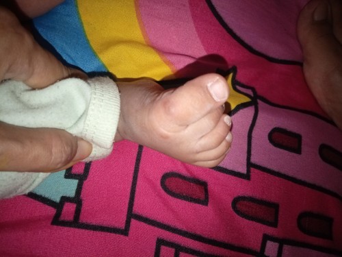 Cacar atau alergi???