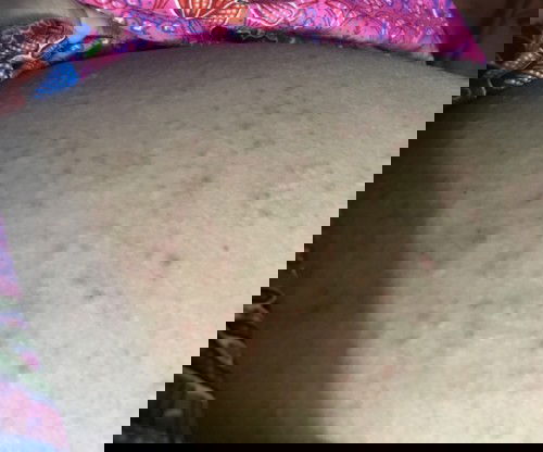 สอบถามหน่อยคะเป็นผื่นคันมากตอนนี้ท้อง19weekเกิดจากอะไรคะคันมากๆเลยคะมียาตัวไหนช่วยได้บ้างคะจะอันตรายมั้ยคะขอบคุณสำหรับคำตอบคะ