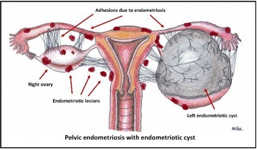 Ectopic vs Endometriosis