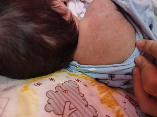 น้องพึ่งได้22วัน มีผื่นที่หลังและหน้า