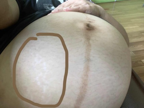 ท้องแตกลาย ใช้อะไรดี🥺