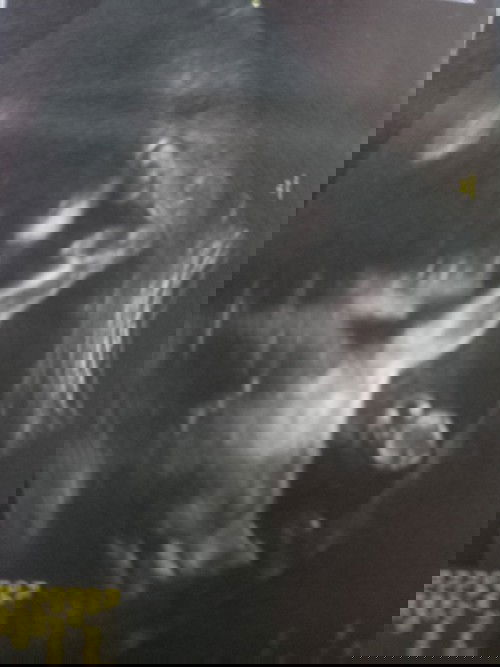 คลอดลูกท่าก้น ขาชี้