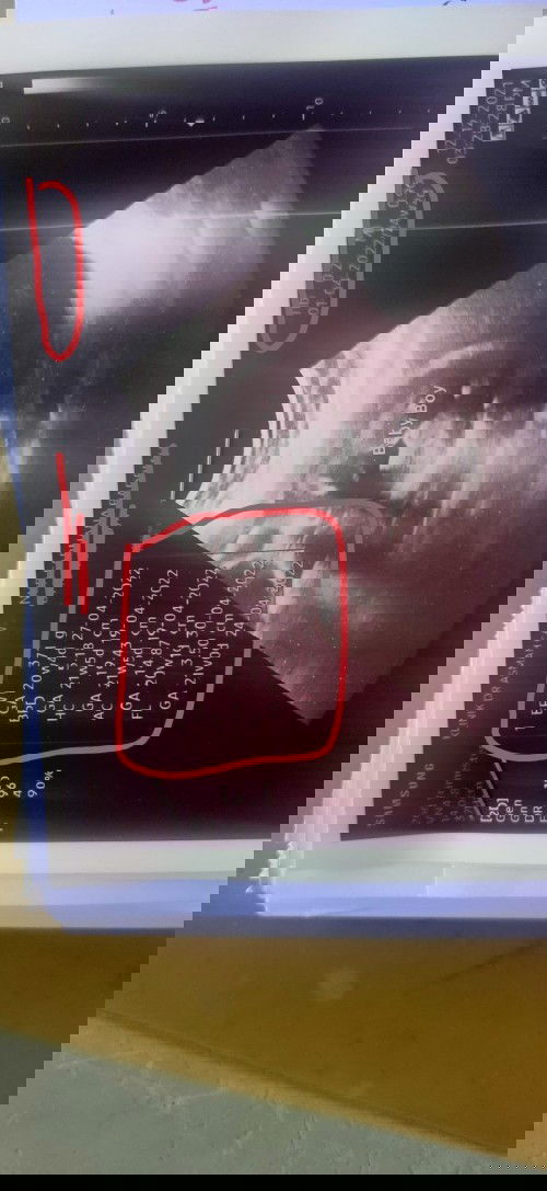 bayi kecil tidak sama dengan usia kehamilan