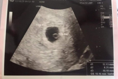5 weeks preggy