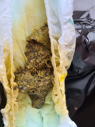 Pasintabi sa poop pic ng anak kong 1yr old, formula fed