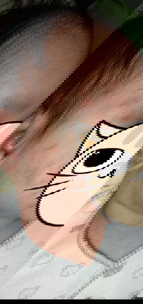 Ruam & bentol di wajah bayi barunlahir