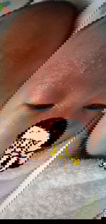 Ruam panas atau kulit sensitif