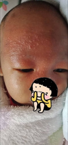 Ruam panas atau kulit sensitif