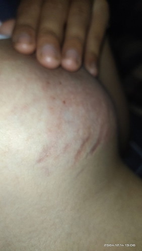 เต้านมคันมากๆเลยค่ะ ต้องใช้ยาตัวไหนดี