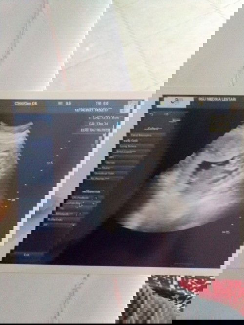 USG 13WEEK Alhamdulillah sehat