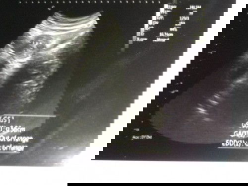 Ukuran kantung kehamilan