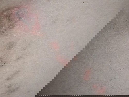 Gatal2 pada ibu hamil