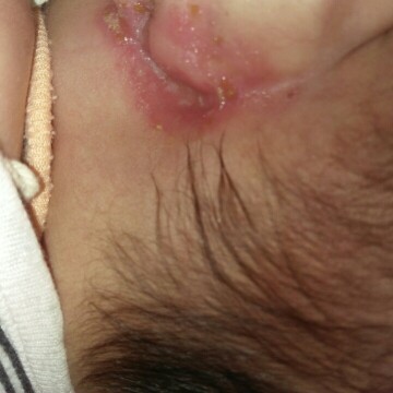 มียาหรือวิธีแนะนำมั้ยคะ
จะหนึ่งอาทิตแล้วค่ะ
ยังม่ทีท่าว่าจะหายเลยค่ะ