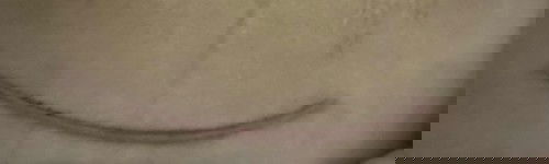 Sinh mổ bao lâu thì lành.