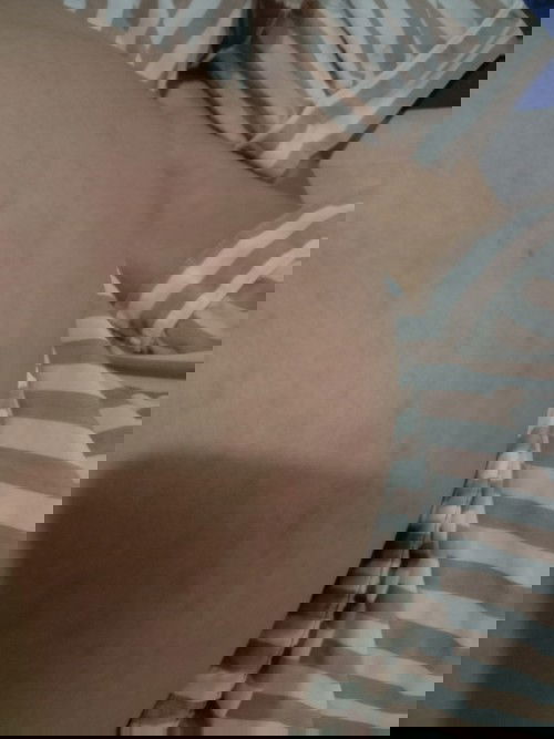 ท้องเป็นผื่นแดงแบบนี้จะรอดไหมคะ