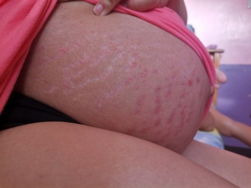 Stretch mark