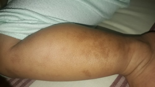 Cream iritasi kulit