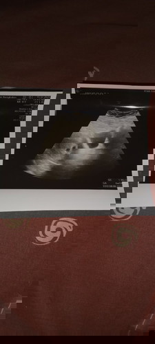 Hamil 8 minggu tp hasil USG 6 minggu flek saya harus bagaimana dan kt dokter bayi tidak berkembang..