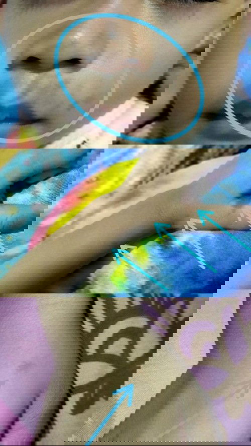 Muncul bercak hitam di kulit