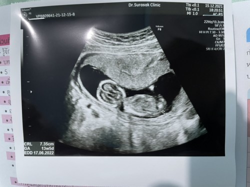 ขอดูรูปซาวด์ท้อง14วีคของแต่ละบ้านหน่อยค่า