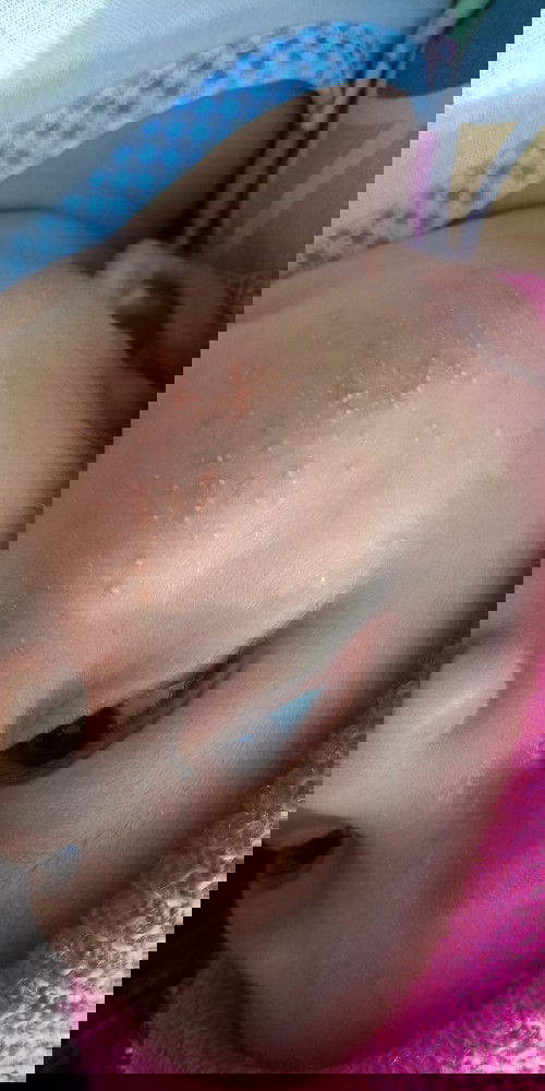 Jerawat kecil pipi bayi