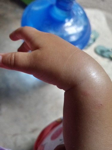 May rabies po ba ang nakagat ng pusa pero di namn dumugo