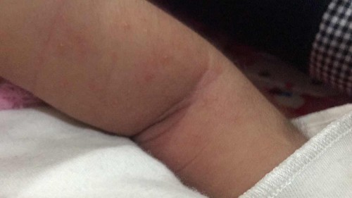 Ilangin biang keringat gmn ya ? Bayi 2 mg pindah rumah jd keluar biang keringat