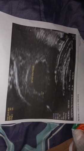 dinyatakan hamil kosong dan janin tidak berkembang