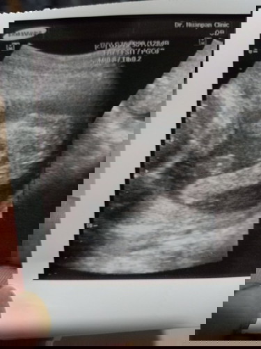 อัลตร้าซาวด์