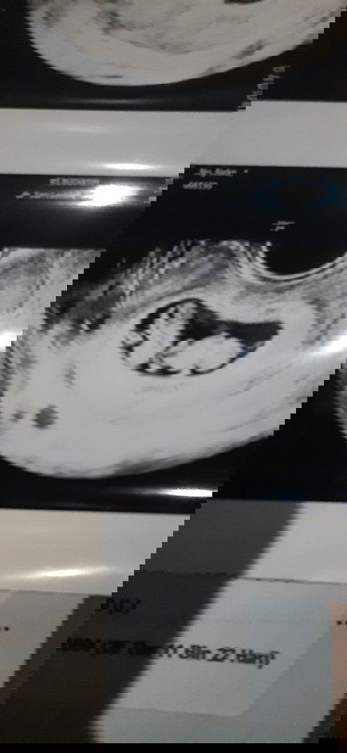 Sharing kehamilan kembar