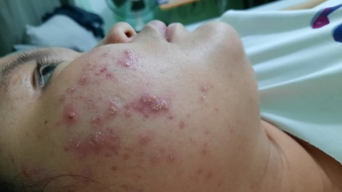 Pregnant pimples