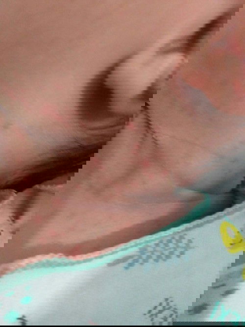 Bintik" merah di leher