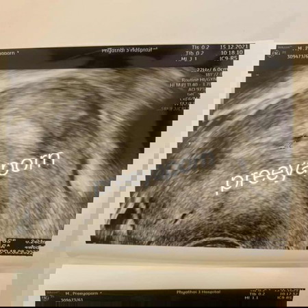 ผลซาวด์ต่ำกว่าอายุครรภ์ที่นับ